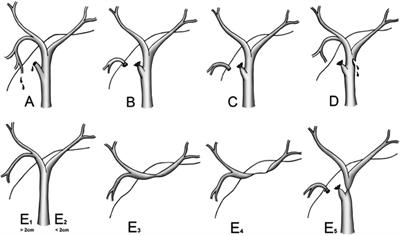 Clinical presentation, management and outcomes of bile duct injuries after laparoscopic cholecystectomy: a 15-year single-center experience in Vietnam